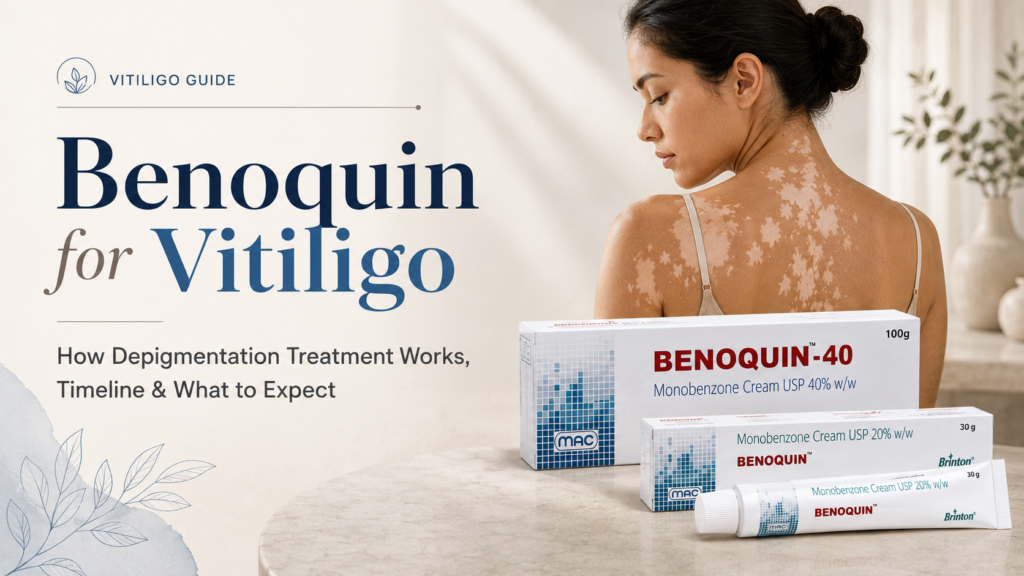 Benoquin for vitiligo